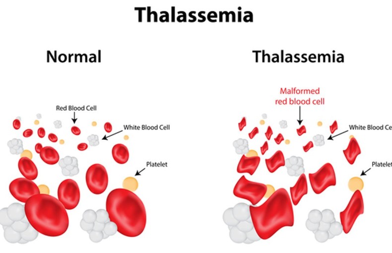 Xét nghiệm di truyền - Thalassemia