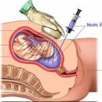 Xét nghiệm di truyền - QF-PCR (13.18.21.X.Y)