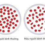 Xét nghiệm di truyền - Thalassemia