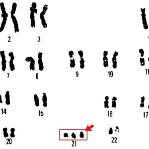 Xét nghiệm di truyền - QF-PCR (13.18.21.X.Y)